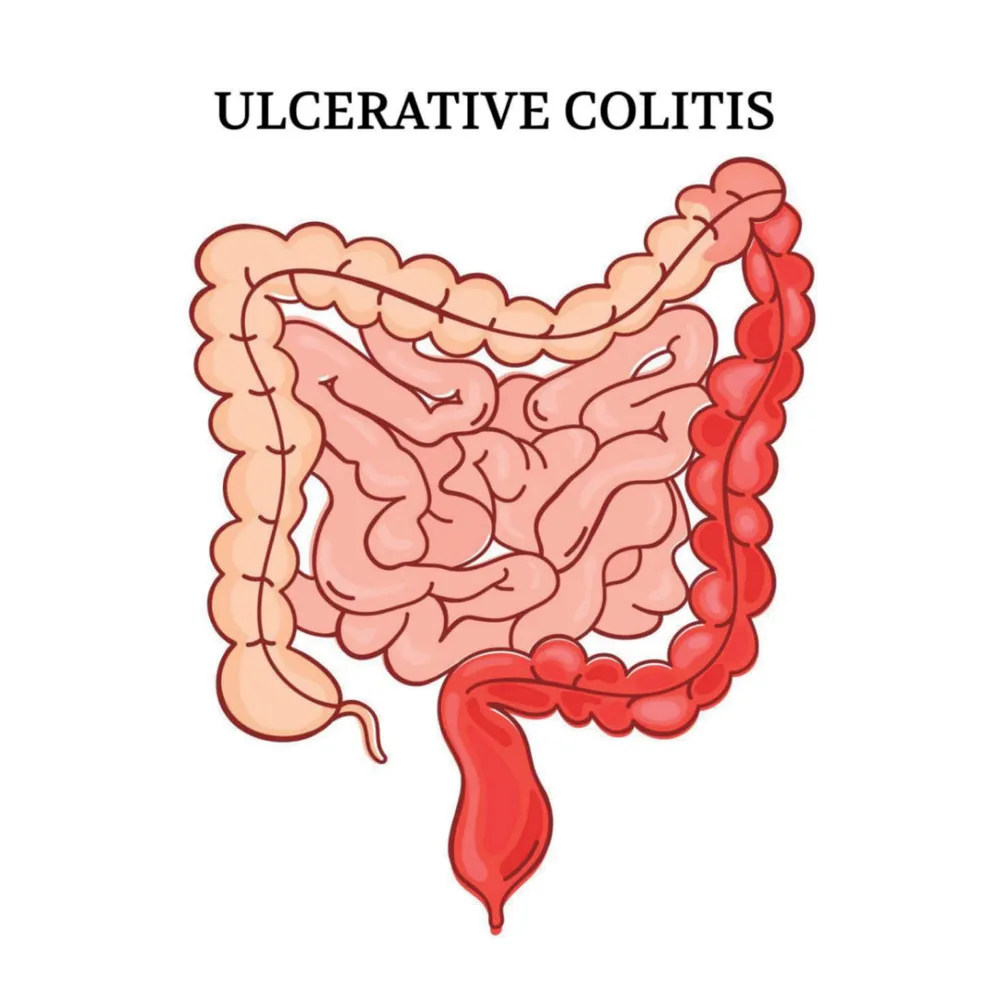 Ulcerative-Colitis-