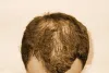 बालों की सही देखभाल पतंजलि वैलनेस इंटरग्रेट थेरेपी
