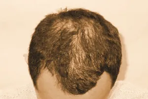 बालों की सही देखभाल पतंजलि वैलनेस इंटिग्रेटेड थेरेपी
